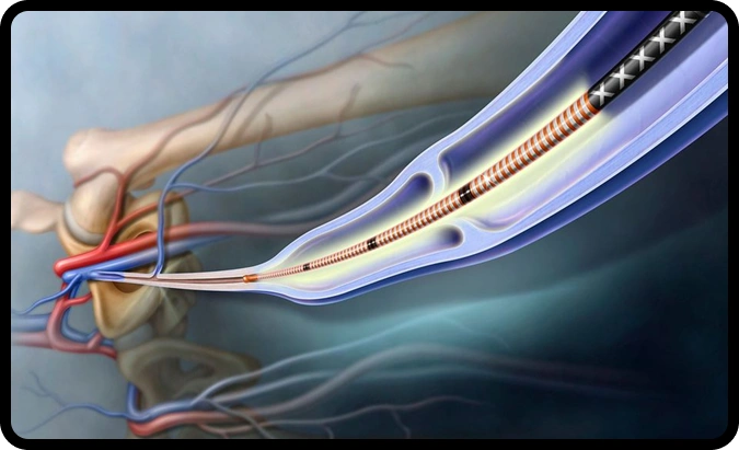 Vascular Access for Hemodialysis, Basilic Vein Transposition - Dr. Amit ...